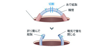 入院の必要がなく日帰りで受けられるパイプカット手術